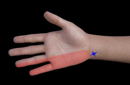 Ulnar nerve impingement at the wrist 