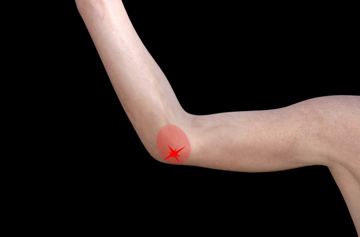 Medial epicondylitis or golfer's elbow