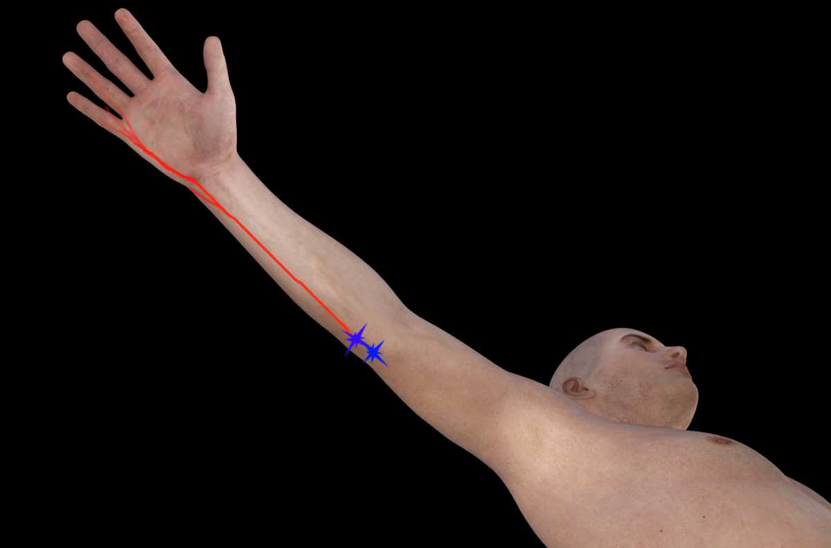 CUBITAL TUNNEL SYNDROME (FOR ULNAR NERVE AT ELBOW) 